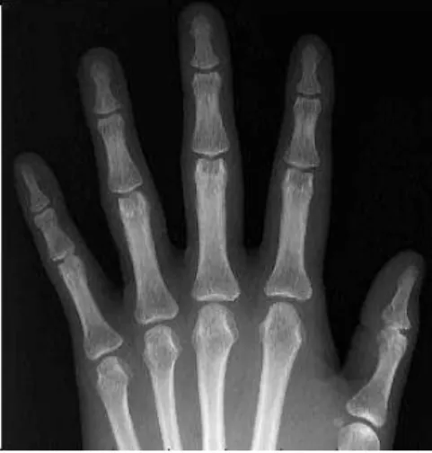 Fig. 8. The hand bone radiograph after applying  the erosion morphological  operation to Fig