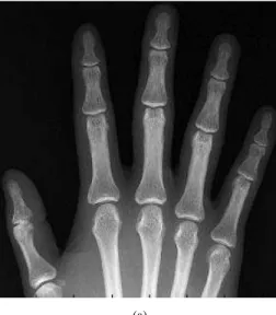 Fig. 16. The  bone  boundary  detection  results  for  the  right  hand  radiograph. 