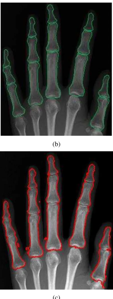 Fig. 17. One failed result of the bone boundary detection. (a) The entropy of  the input image after applying the PMD filter