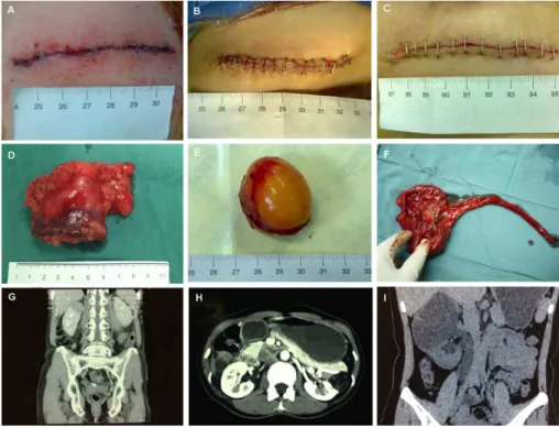 Figure 1. The supra-12th rib mini-flank approach for managing renal lesions. Renal clear cell carcinoma in the upper pole of the right side (A, D, G): The length of incision after MI-OPN (A); The length of the lesion after MI-OPN (D); Coronal reconstructio