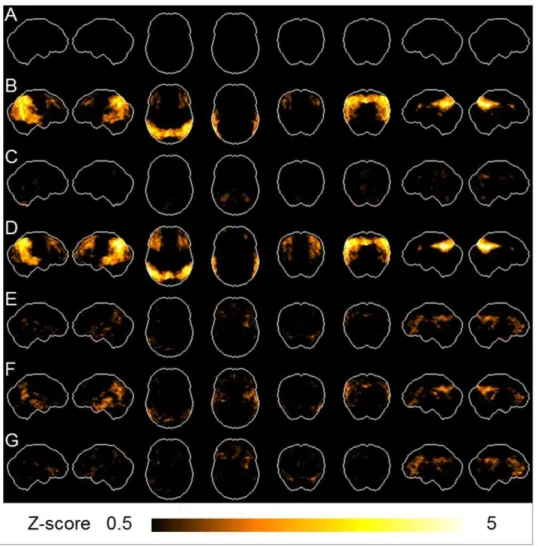 Figure 2. 3D-SSP images. Employing 20 NL subjects in Category A as a reference database, all subjects’ 3D-SSP Z-score images were prepared.