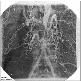 Figure 6. Infrarenal coarctation in a fifty­five­year­old female patient
