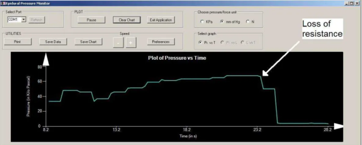 Figure 2. Software output clearly showing LOR.
