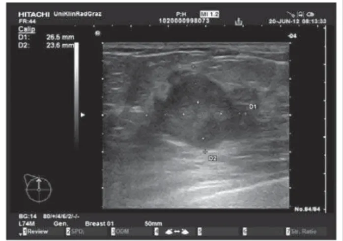 Abbildung 1: Suspekter Knoten der linken Brust in der Mammasonographie