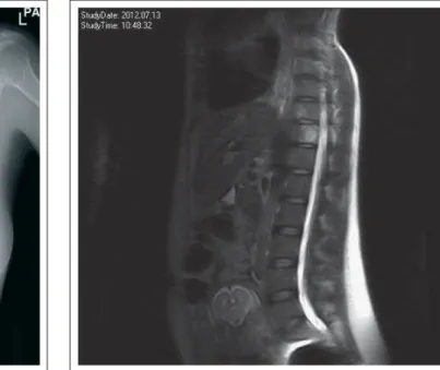 Abbildung 3: Wirbelkörpermetastase BWK-10, 11, 12 und LWK-4, dargestellt in der  seitlichen Röntgenaufnahme