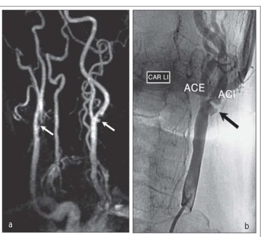 Abbildung 4: (a) MR-Angiographie der Karotiden. Bds. findet sich eine Stenose der A. carotis interna: