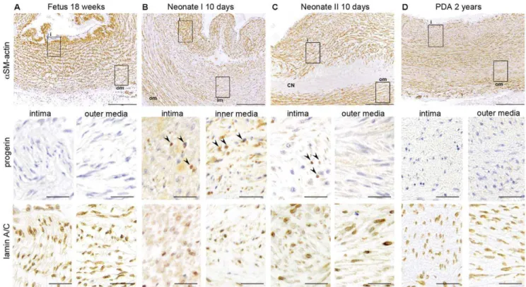 Figure 5. Spatial and temporal expression of progerin is associated with development of CN in the DA