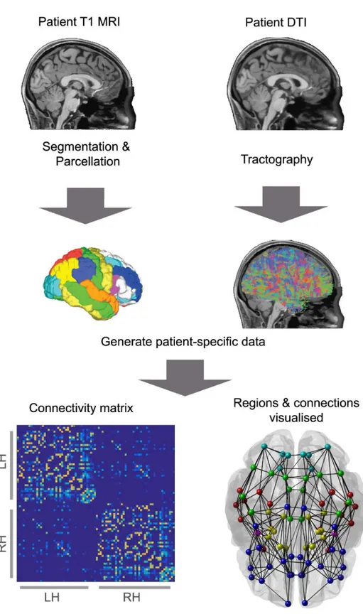 Fig 6. The creation of a connectome. A diagrammatic representation of the connectome creation process, combining information from T1 MRI and DTI to create a network formed from brain regions connected by white matter fibres