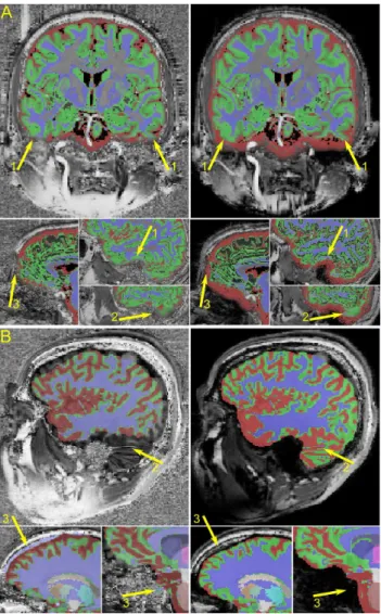 Figure 6. Percentage differences between repeat scans of the segmentation results when utilizing the uniform and robust T1w image