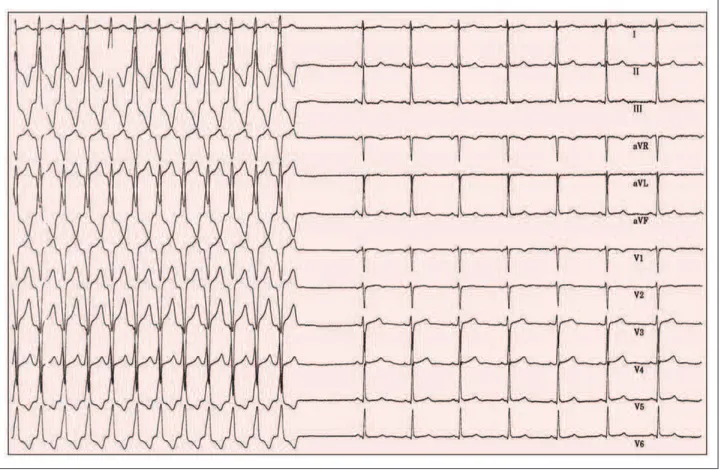 Abbildung 1: Breitkomplextachykardie mit Kammerfrequenz um 170/min, Linksschenkelblock, Übergang in Sinusrhythmus 75/min, Steiltyp, diskret erhöhter ST-Streckenab- ST-Streckenab-gang v3 bis v6.
