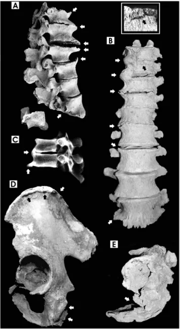 Figure 2. Pathological features of spine and pelvis. A.