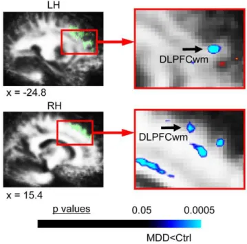 Figure 2. FA differences in MDD subjects in secondary a priori areas of evaluation. This figure shows the significant FA differences in MDD subjects versus matched healthy controls for the voxel-based contrast (all subjects: 22 MDD, 22 controls) in a prior