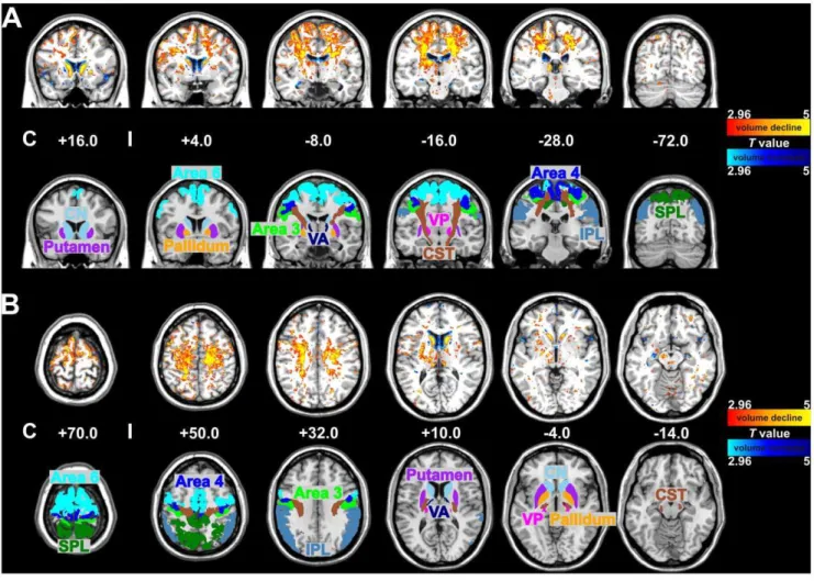 Figure 1. Statistical maps (A: coronal and B: axial sections) of voxel-wise volume differences (upper trace) in comparison to probabilistic maps of cytoarchitectonically defined areas (lower trace) between 6 CBS patients and 11 age- and sex-matched control