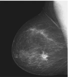 Figure 3:  Mammography before and after the noise reduction .