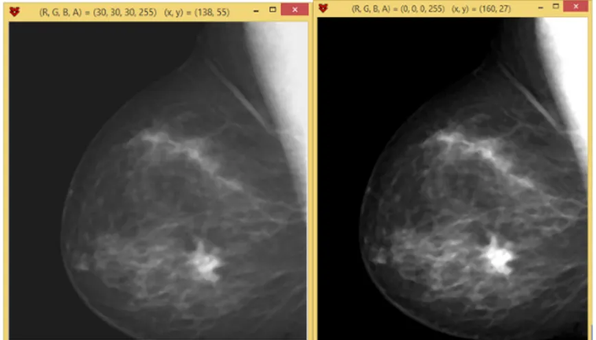 Figure 8:  Mammography before and after contrast improvement .