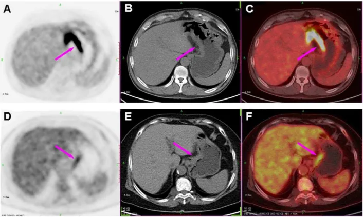 Figure 4. Comparison of PGL and AGC with representative cases. PET (left column), CT (middle column) and PET/CT fused images (right column) of a 56-year-old male with diffuse large B-cell lymphoma (A, B and C) and a 69-year-old female with poorly different