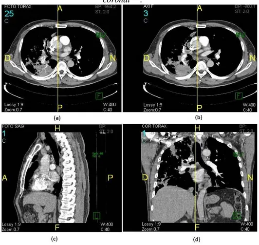 Figura 1.  Imagen tomográfica de CT de un tórax, (a) y (b) es una visualiza- visualiza-ción axial de dos cortes diferentes, (c) visualizavisualiza-ción sagital y (d) visualizavisualiza-ción 