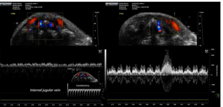 Fig 17. Eco-color doppler with pulsed doppler analysis of veins. (A)The internal jugular vein waveform is characterized by a monophasic pattern and low pulsatility index
