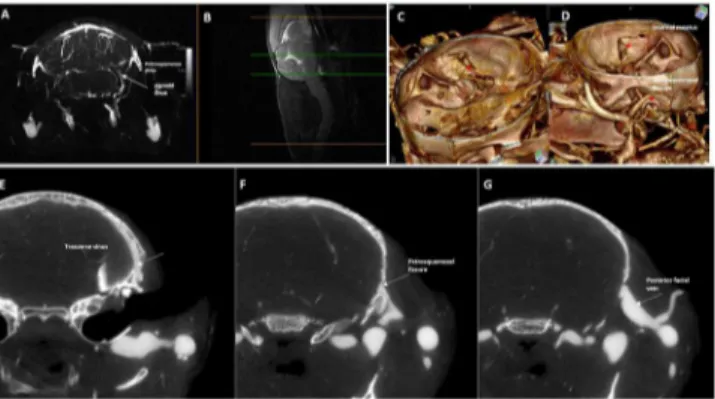 Fig 8. Magnetic resonance angiography with 3D rendering and silicon-computed tomography angiography of the petrosquamosal fissure