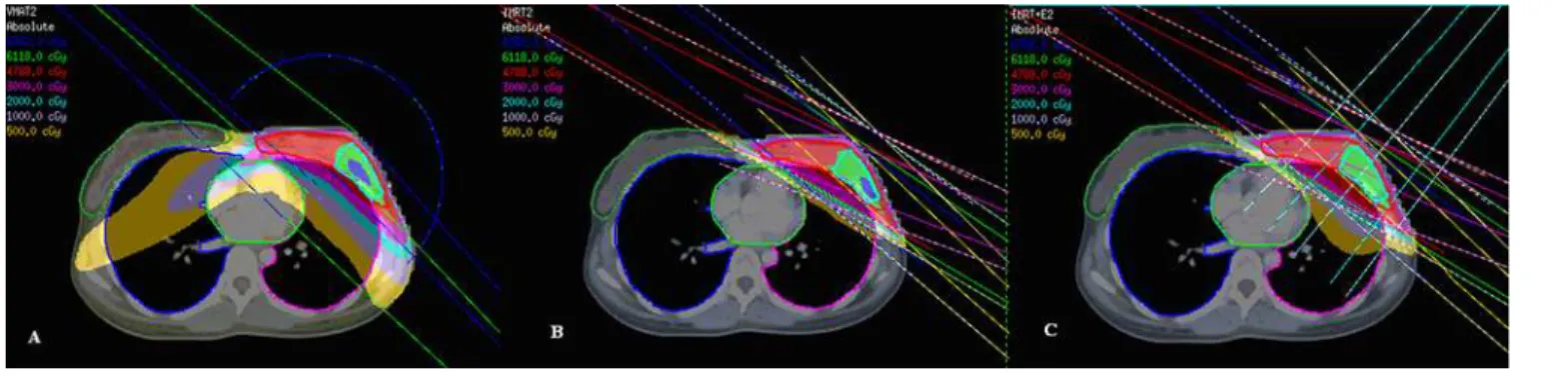Fig 1. Beam arrangement, target coverage, and doses to normal organs in VMAT (A), IMRT (B), and IMRT-EB (C).