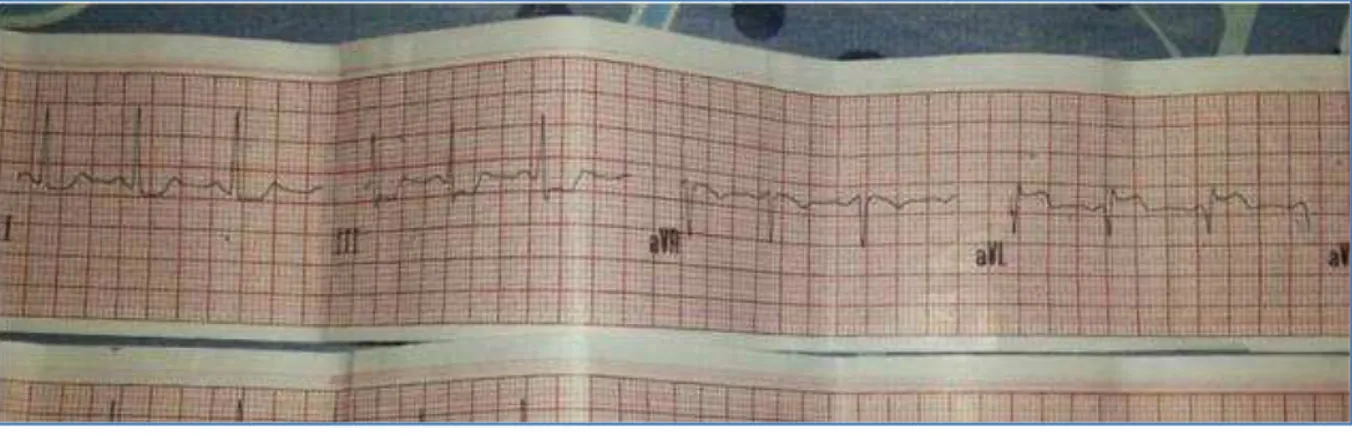 Fig. 1: S T segment ellevation in lead aVL and ST depression in lead III