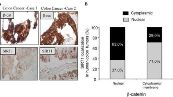 Figure 5. SIRT1 expression occurs in a subset of human colon cancers and inversely correlates with the nuclear localization of b-catenin