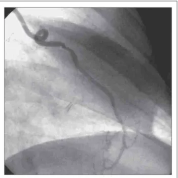 Abbildung 1: Beispiel eines ATI-Bypasses auf den Ramus interventricularis anterior 8 Jahre nach Implantation in MIDCAB-Technik.