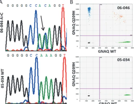 Fig 2. GNAQ A209H mutation in UM 06 – 046. (A) GNAQ mutation in 06 – 046 involves the c.627 A>C that encodes for the Q209H substitution
