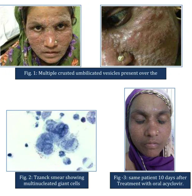 Fig. 1: Multiple crusted umbilicated vesicles present over the  face.