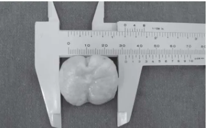 Figura 1. Mensuração da glândula prostática realizada por meio do paquímetro, demonstrando a medida látero-lateral.