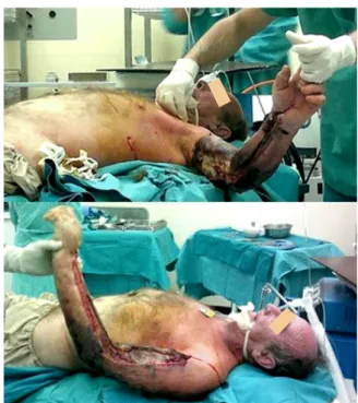 Fig. 2 – Streptococcal necrotizing faciitis of the left upper  limb and chest before amputation of the arm at the shoulder