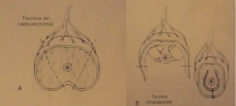 Figura  8A:  representação  esquemática  da  técnica  de  prostatectomia  parcial. 