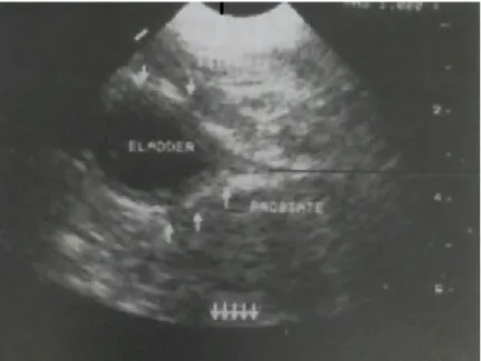 Figura  6:  imagem  ultrassonográfica  de  um  cão  com  Hiperplasia  Prostática Benigna com estreitamento uretral, indicado pelo traço preto