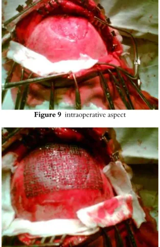 Figure 10  intraoperative aspect 