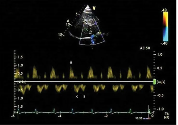 Fig 2. Four-phasic Doppler flow spectra of the MHV in the pulmonary hypertension (PH) group