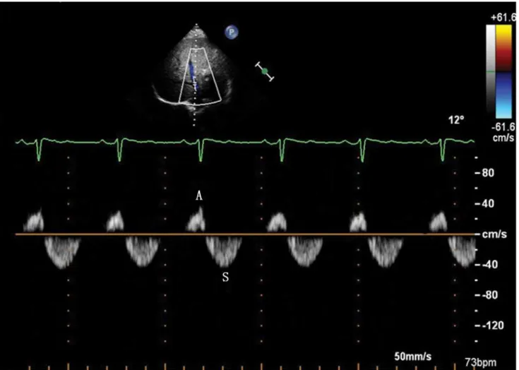 Fig 3. Bi-phasic Doppler flow spectra of the MHV in the PH group. Doppler spectra of MHV obtained from a patient with patent ductus arteriosus with the MPAP of 96 mmHg