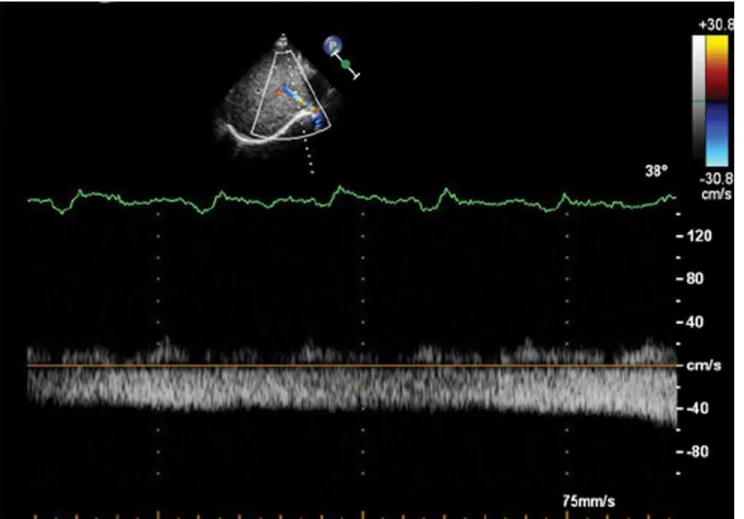 Fig 4. Mono-phasic Doppler flow spectra of the MHV in the PH group. Doppler spectra of MHV obtained from a patient with atrial septal defect with the MPAP of 33 mmHg