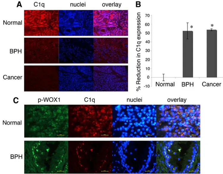 Figure 7. C1q is expressed in normal archival prostate tissue samples and is significantly downregulated in benign prostatic hyperplasia (BPH) and prostate cancer