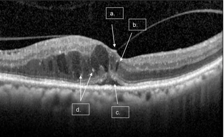 Fig 1. A single scan with macular fluid and Diffuse Retina Edema. Arrows points to the following features: a) Vitreomacular traction (VMT), b) Intraretinal Fluid (IRF); c) Subretinal Fluid (SRF), d) Hyper-reflective Foci (HRF).
