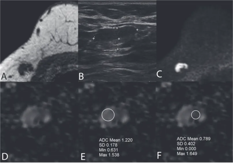 Fig 1. A false positive lymph node due to thickened cortex was true negative on DWI (A-F)