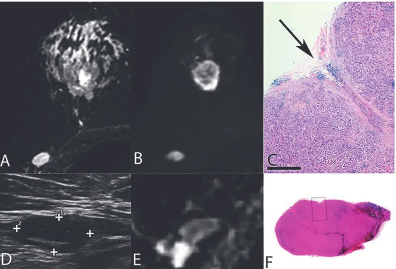 Fig 2. A core biopsied lymph node. Final histopathology indicating true-positive US and DWI findings with metastases (A-F)