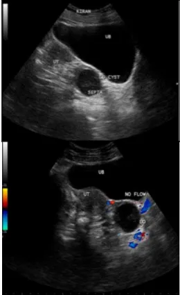 Fig. 1: Ultrasound Pelvis showing a Well-Defined Cystic  Lesion with Internal Echoes and Posterior Acoustic 