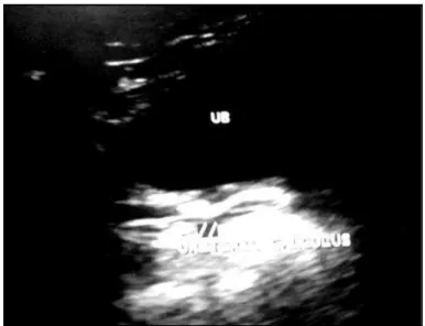 Fig. 7: Ultrasound Abdomen showing Dilated  Ureter with a Calculus near its Terminal 