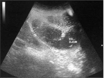 Fig. 10: Small Bowel Obstruction. Multiple Dilated, Fluid  Filled, Aperistaltic Bowel Loops Are Present with a  