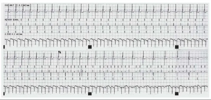 Abbildung 1:  Das 12-Ableitungs-EKG (25 mm/sec) von Patient Nr. 7 zeigte bei Aufnahme das Bild einer Sinustachykardie mit biventrikulärer Stimulation mit einer Frequenz von 120 Aktionen/Min.