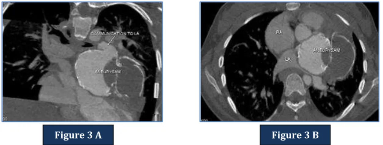 Figure  4  (A,  B,  C  and  D)-  Cardiac  MRI  Axial  and  sagittal  images  revealed  a  partially  thrombosed  bilobed aneurysm of the left atrial appendage