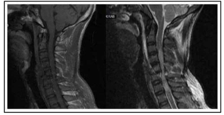 Figure 5: Mid sagittal T2W, T1W, STIR images-tear-drop fracture of C5 vertebral  body with cord compression by retropulsed C5 &amp; cord haemorrhage (C2-C7), 