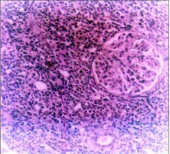 FIGURE 1.  Small intestine lymphoepithelial lesions with crypt elonga- elonga-tion and flattened mucosa (H&amp;E, ×40).