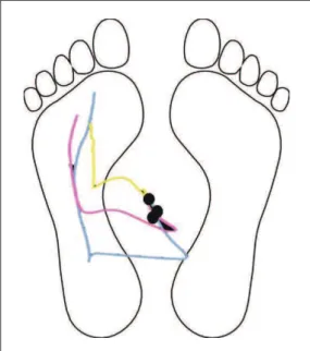 Figure 3. Effects of DBS surgery and levodopa on postural stability in response  to external perturbations