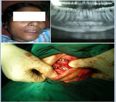 Fig. 12-16: 35years old male patient presented with fracture mandible with soft  tissue injury following RTA